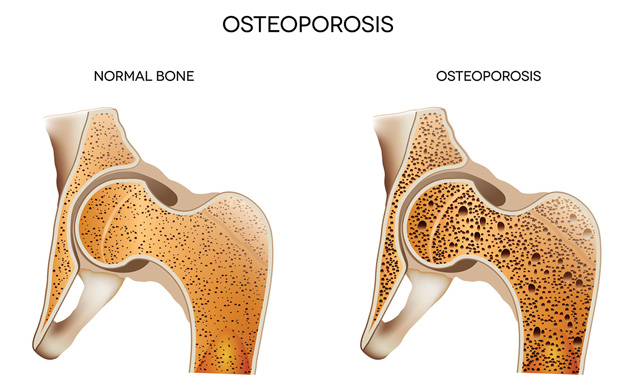 Diagram Comparing Healthy Bone vs. Bones with Osteoporosis
